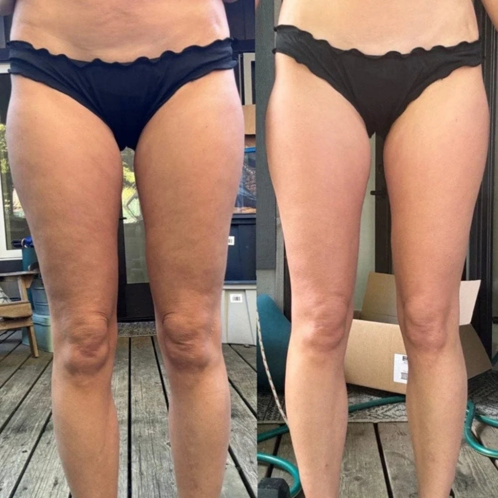 GlowUp - Anti-Cellulite Massager